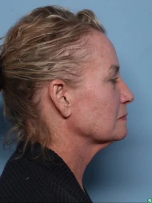Facelift