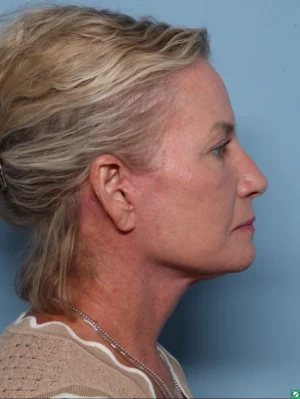 Facelift