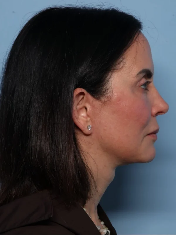 Facelift