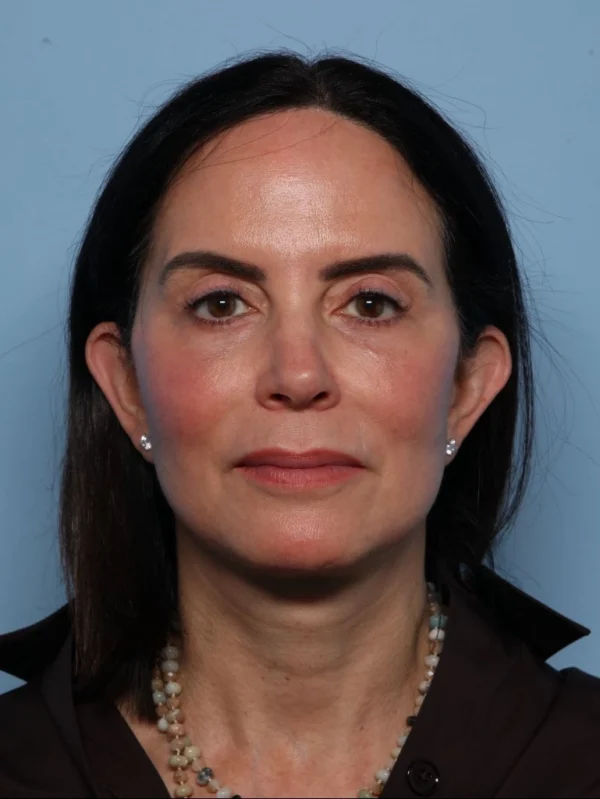 Facelift