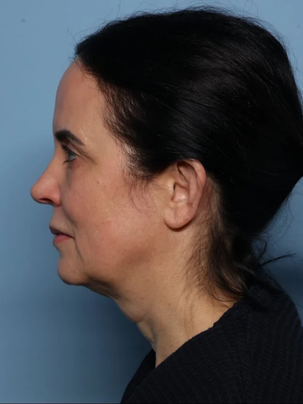 Facelift