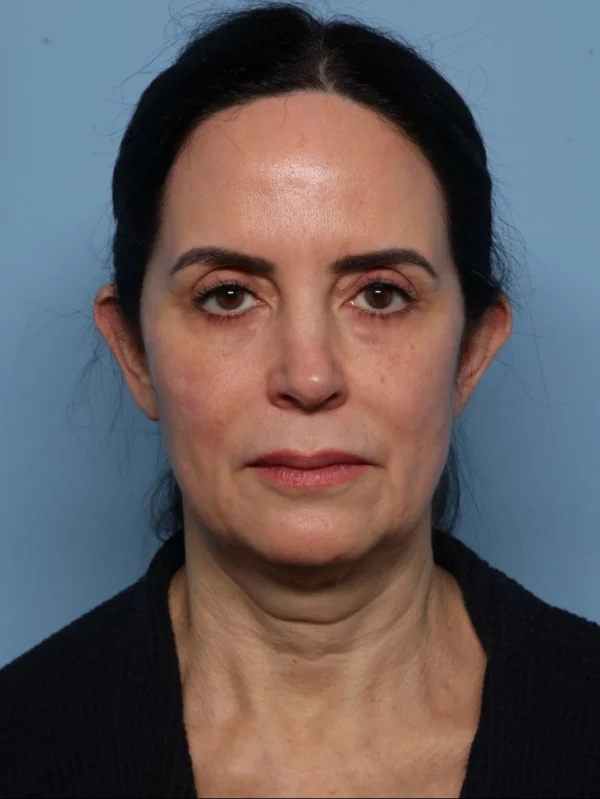 Facelift
