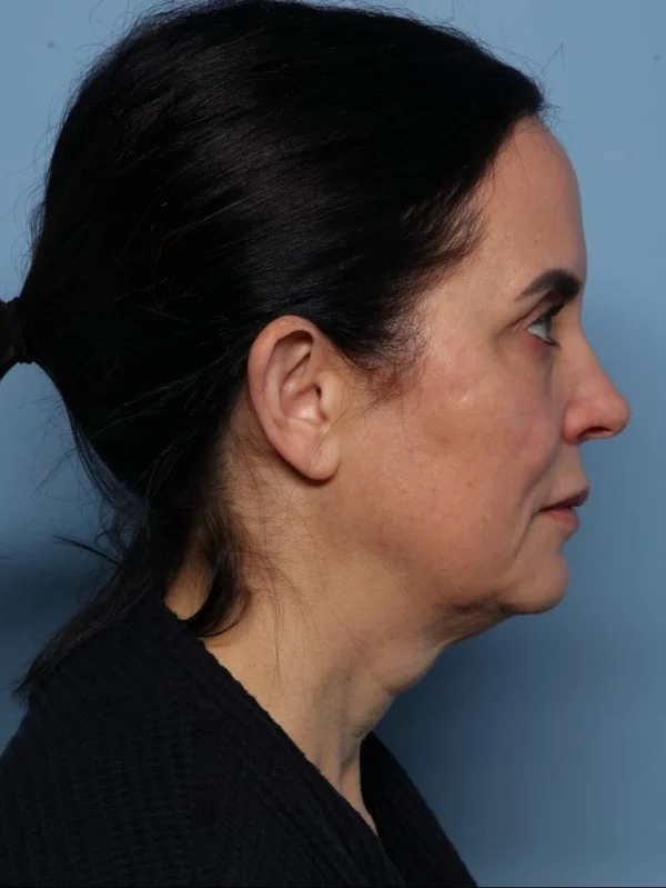 Facelift