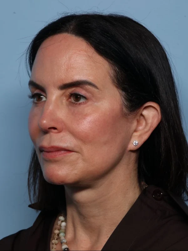 Facelift