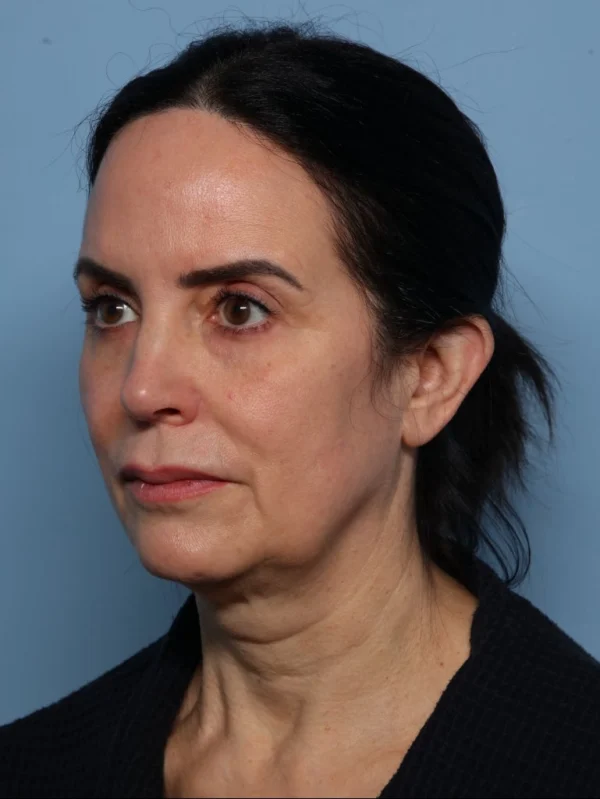 Facelift