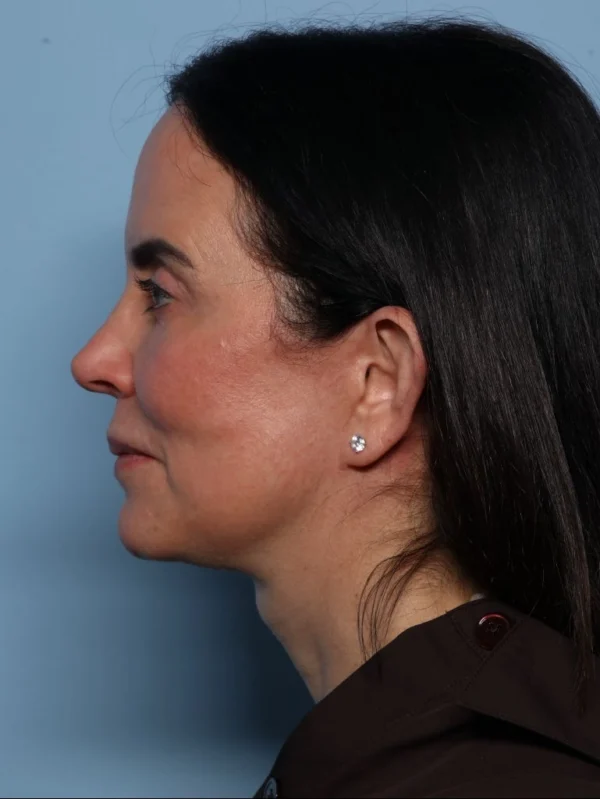 Facelift