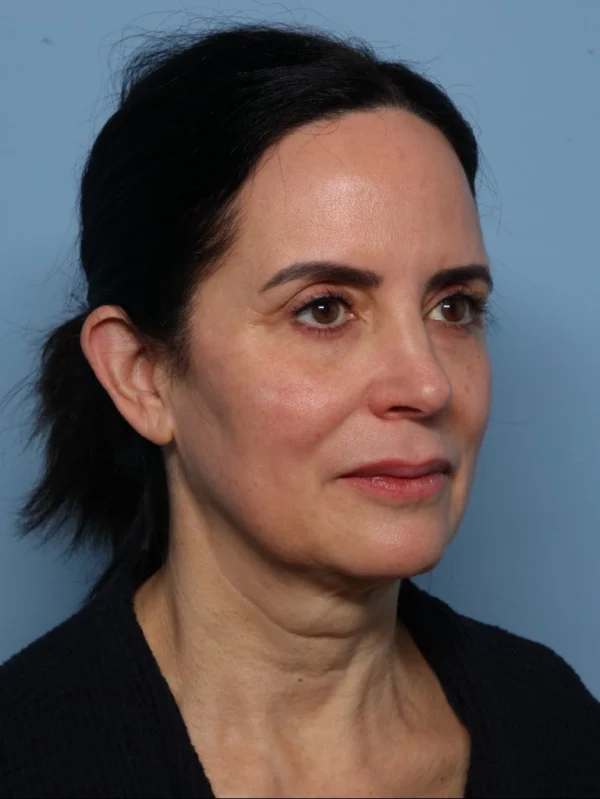 Facelift
