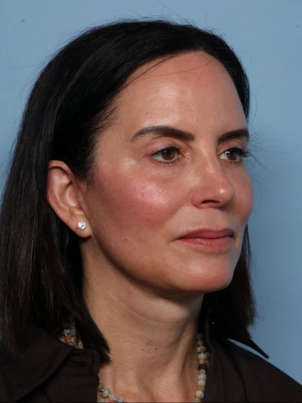 Facelift
