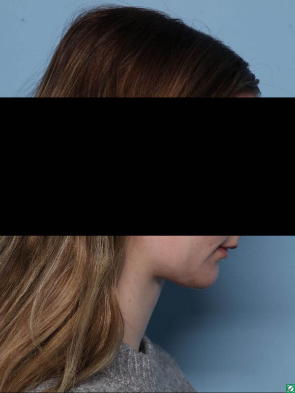 Deep Necklift