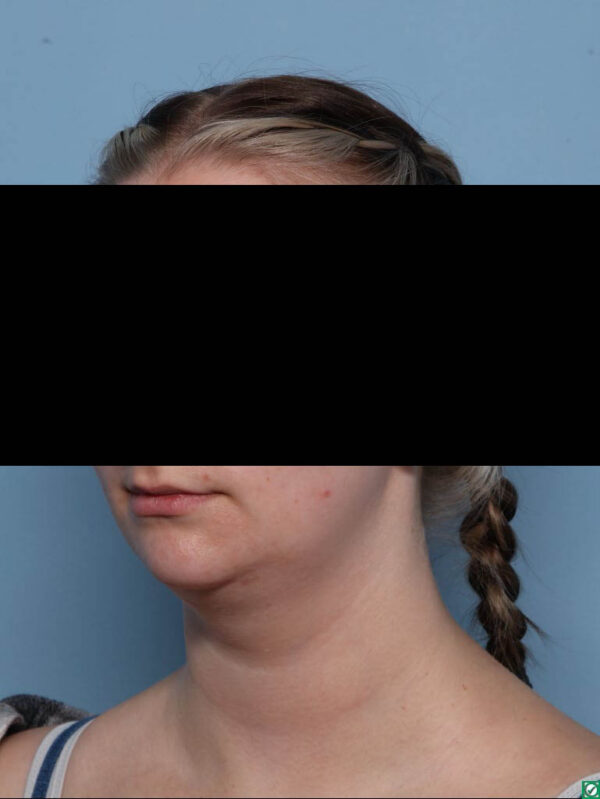 Deep Necklift