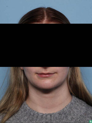 Deep Necklift