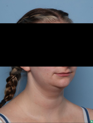 Deep Necklift