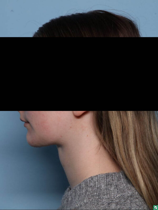 Deep Necklift