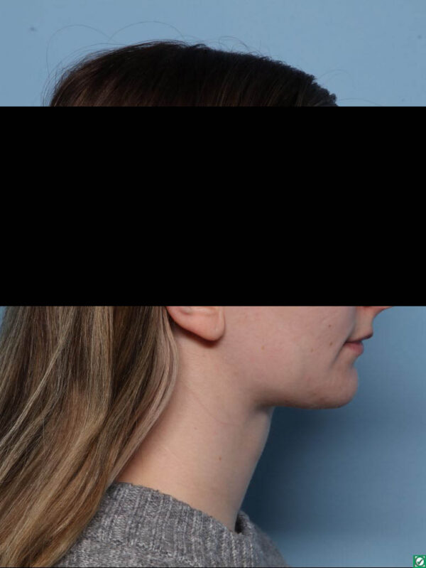 Deep Necklift