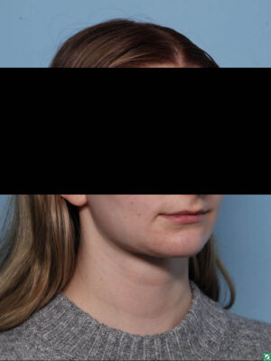Deep Necklift