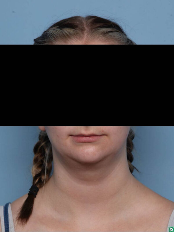 Deep Necklift