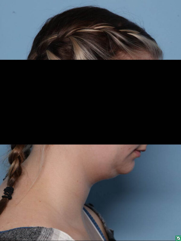 Deep Necklift