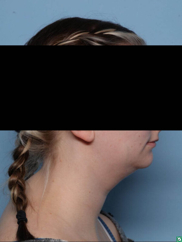 Deep Necklift