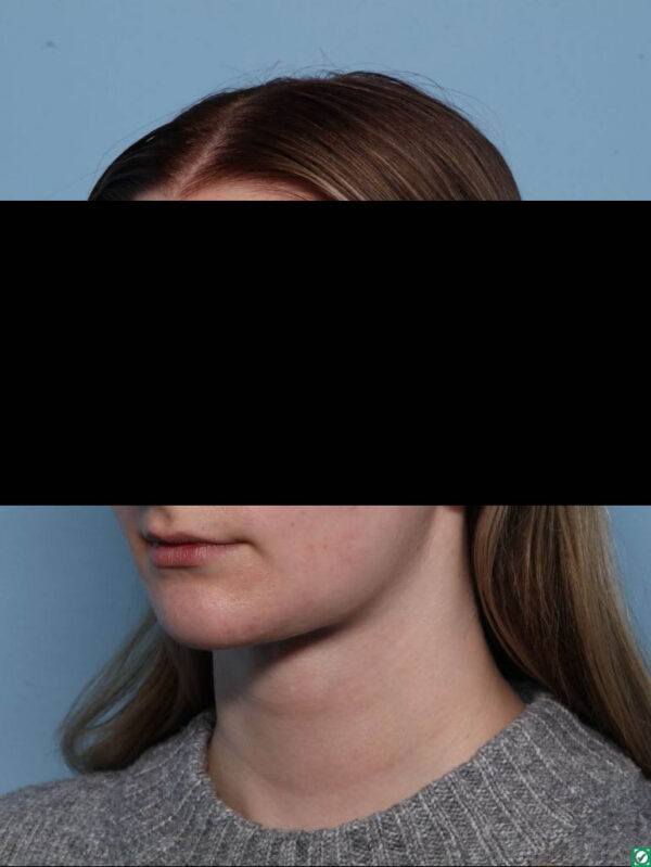 Deep Necklift