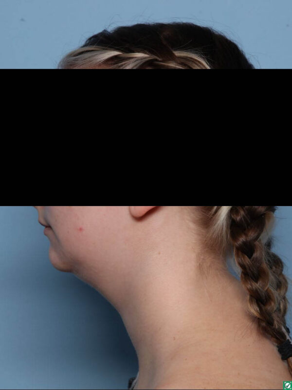 Deep Necklift
