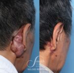 Experience life-changing transformations with Smith Facial Plastics!

👤 Surgeon: Dr. Stephen Smith
🎯 Treated Area: Keloid behind ear
⭐ Procedure: In-office CO2 laser excision of a keloid scar, followed by steroid injections and pulsed-dye laser management.
📍 Location: Walnut Creek Wellness Center
😍 Results: Life Changing!
✏️ Note: Individual results may vary. 
©️ Smith Facial Plastics. This is an actual patient who has consented to the use of these photos. Please do not copy or distribute without permission.

👉 Tap the link in our bio to schedule your consultation. 
____________________________
📞 614.245.4263
📍 Columbus, Ohio
🌐 smithfacialplastics.com
👤 Facebook: Smith Facial Plastics
▶️ YouTube: smithfacialplastics
🎵 TikTok: smithfacialplastics
 #ModaEsthetica